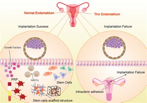 Understanding Thin Endometrium: Causes, Effects on Fertility, .